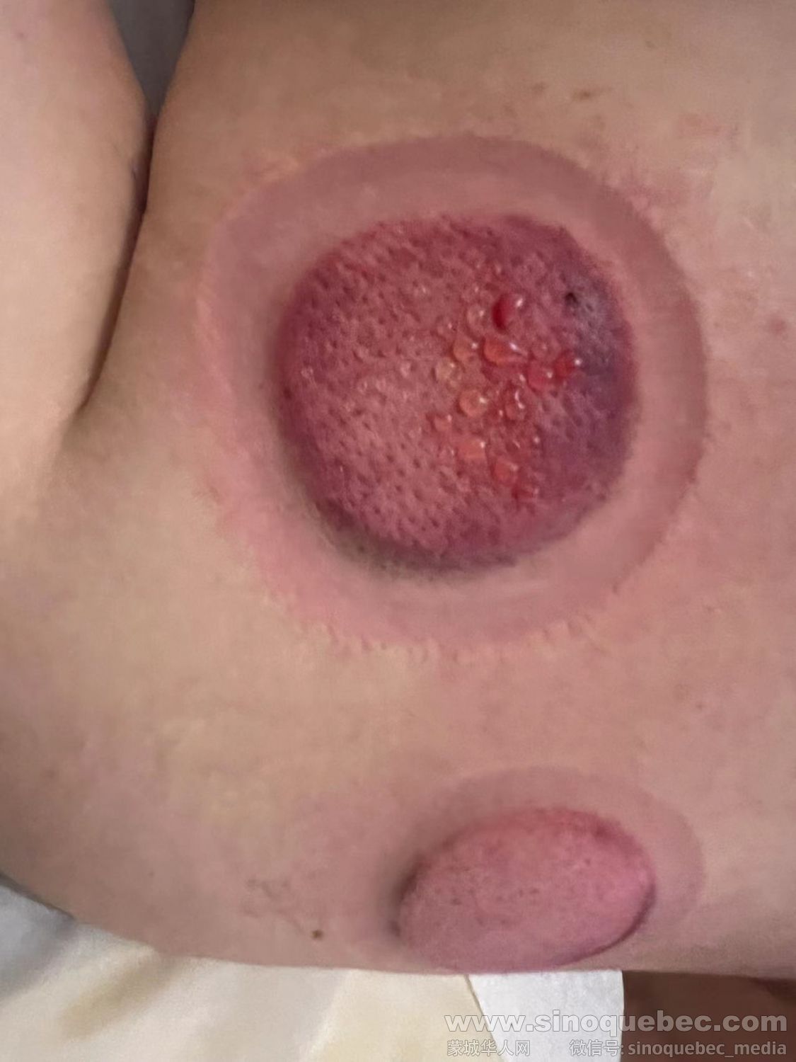 拔罐
