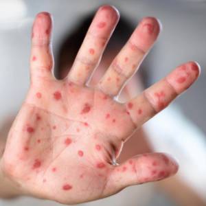 蒙特利尔确认两新麻疹病例 检查自己是否被感染