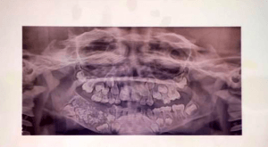 印度7岁男孩下颚肿胀 医生从他口中拔出526颗牙