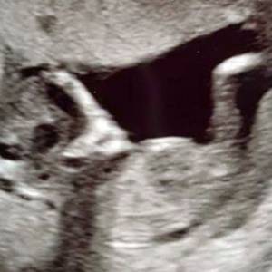 英国一孕妇孕检照片发现“外星人脸” 吓坏准妈妈