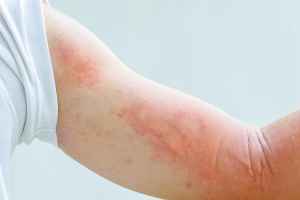 卫生官员敦促魁省民众接种麻疹疫苗