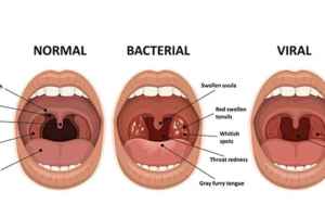 新的扁桃体切除术在魁省得到推广
