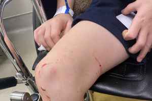 一名美国男孩在Jean-Drapeau公园 人工湖游泳时被鱼攻击