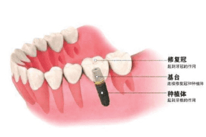 在魁省做一颗种植牙要花多少钱？